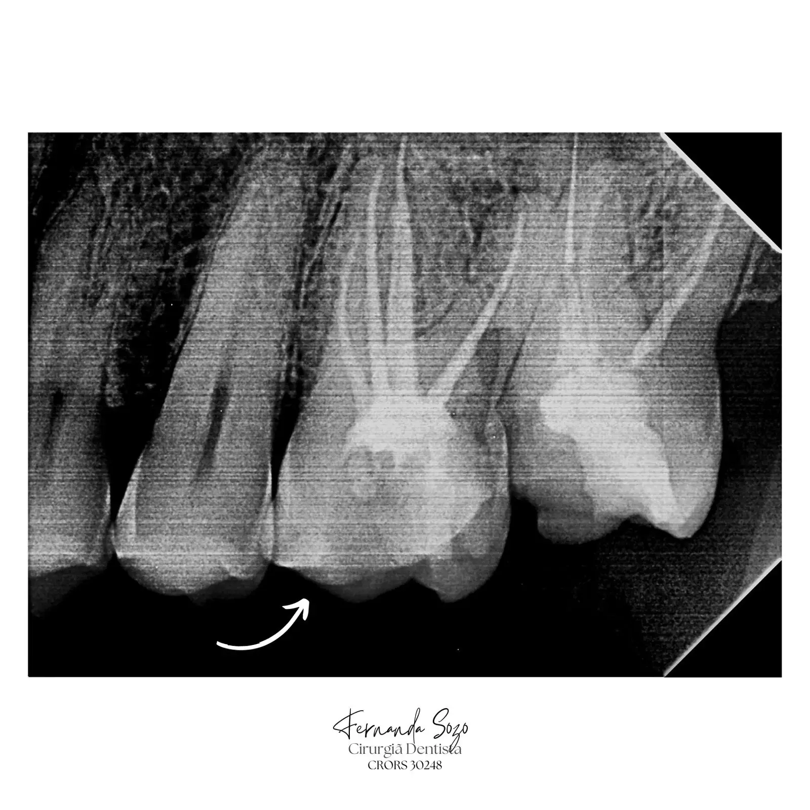 Retratamento de molar com perfuração radicular