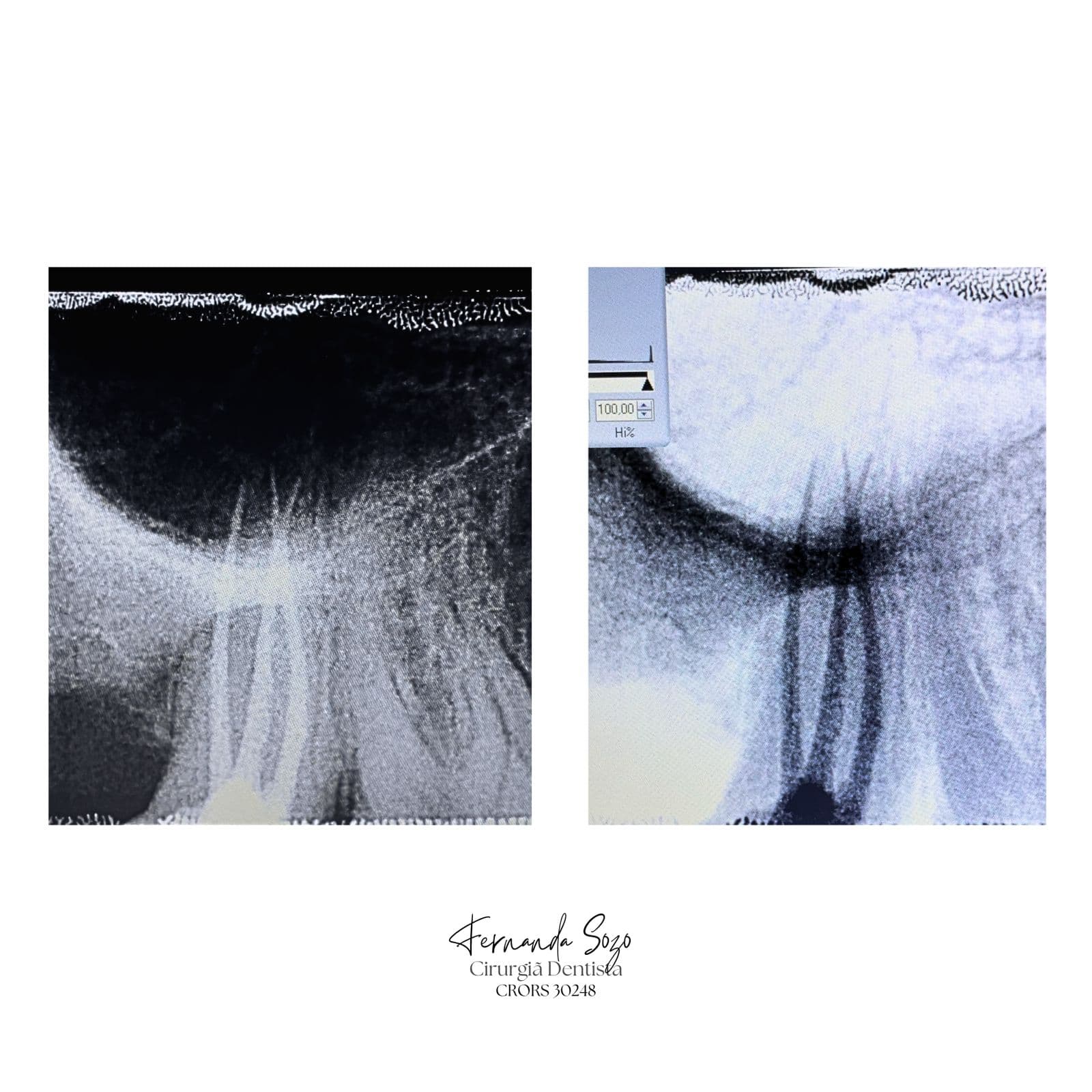Endodontia de segundo molar inferior com canais curvos