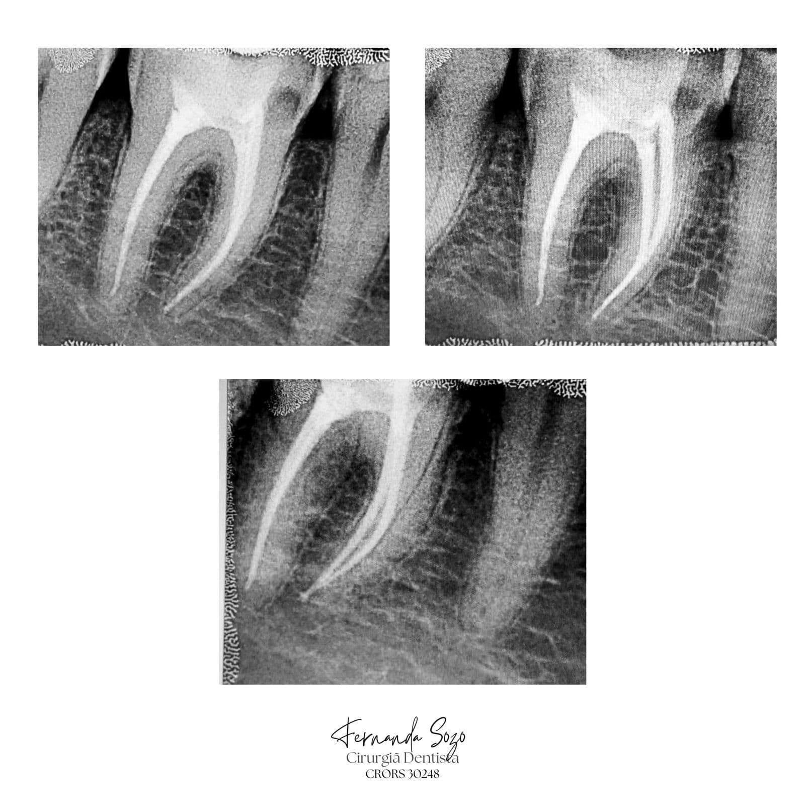 Tratamento de canal em primeiro molar superior com sucesso