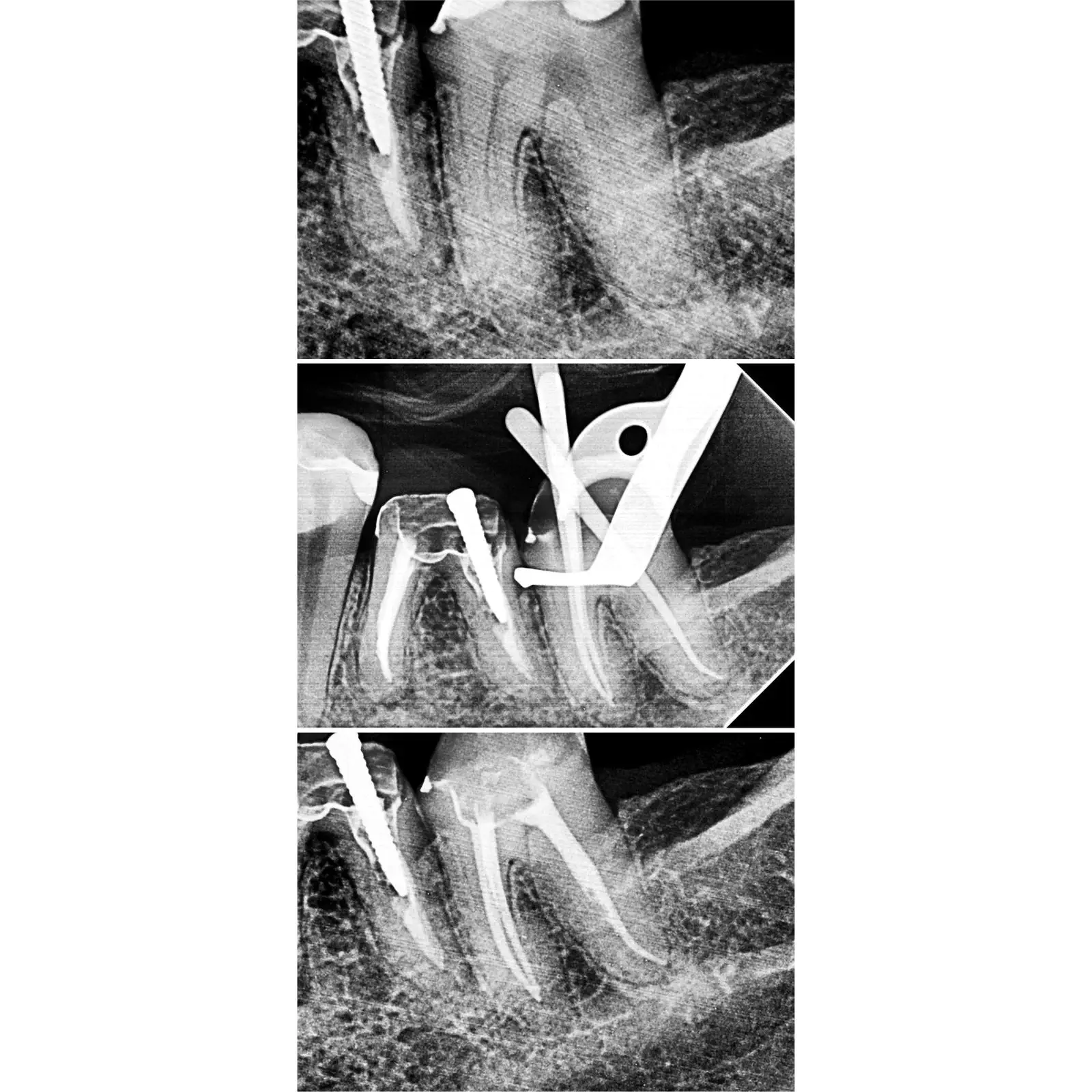 Tratamento de canal calcificado em canino superior