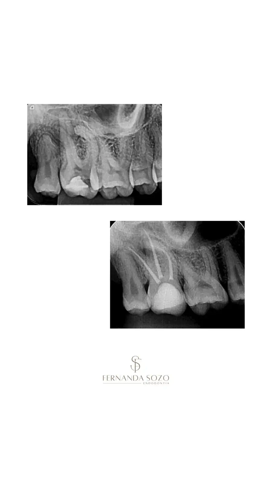 Tratamento endodôntico de urgência em molar com abscesso