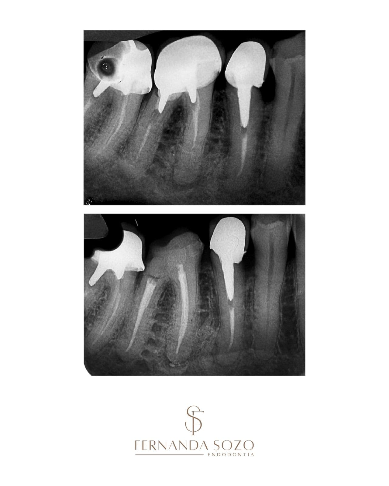 Tratamento endodôntico de molar inferior com três canais radiculares
