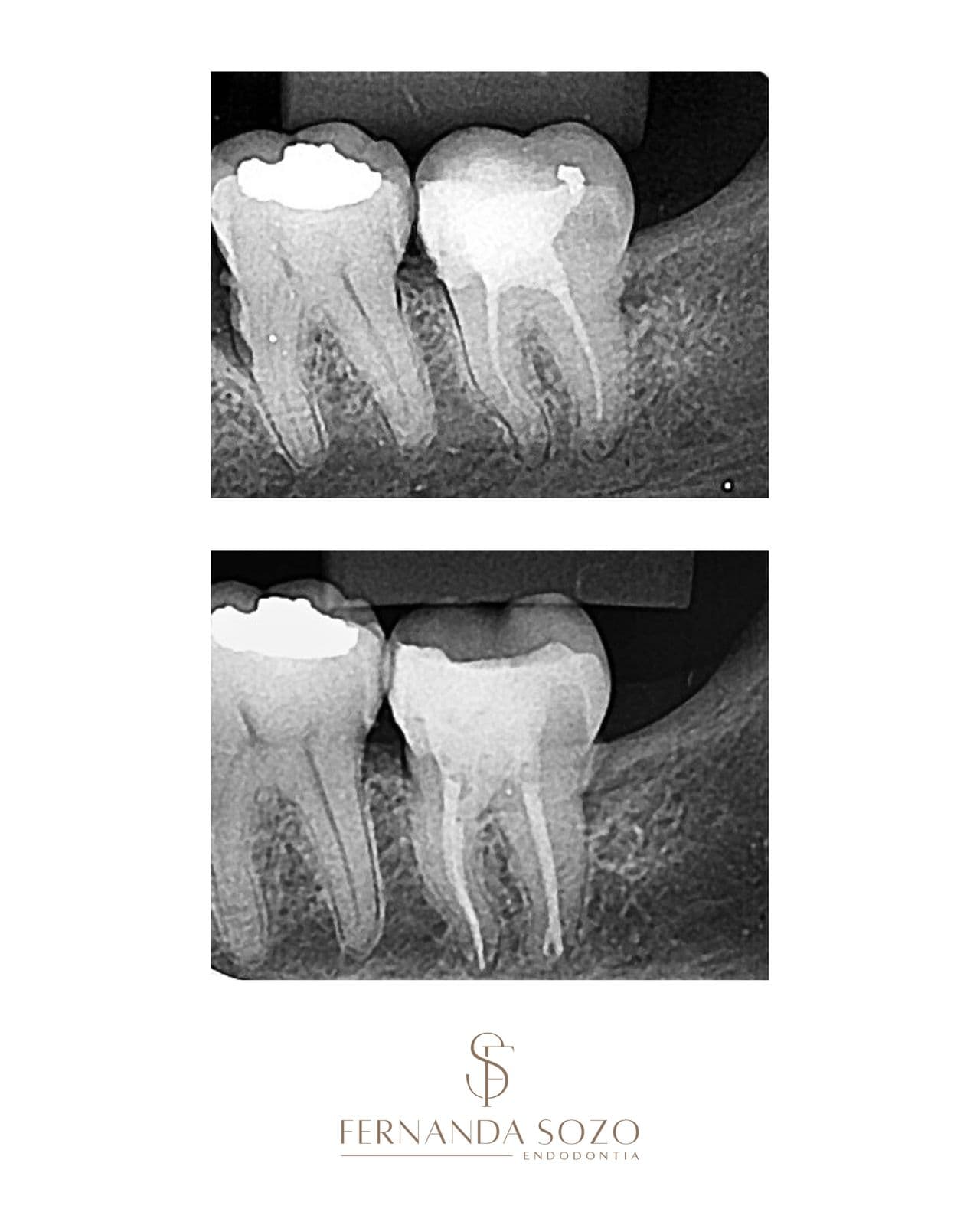Tratamento endodôntico de molar inferior com três canais radiculares