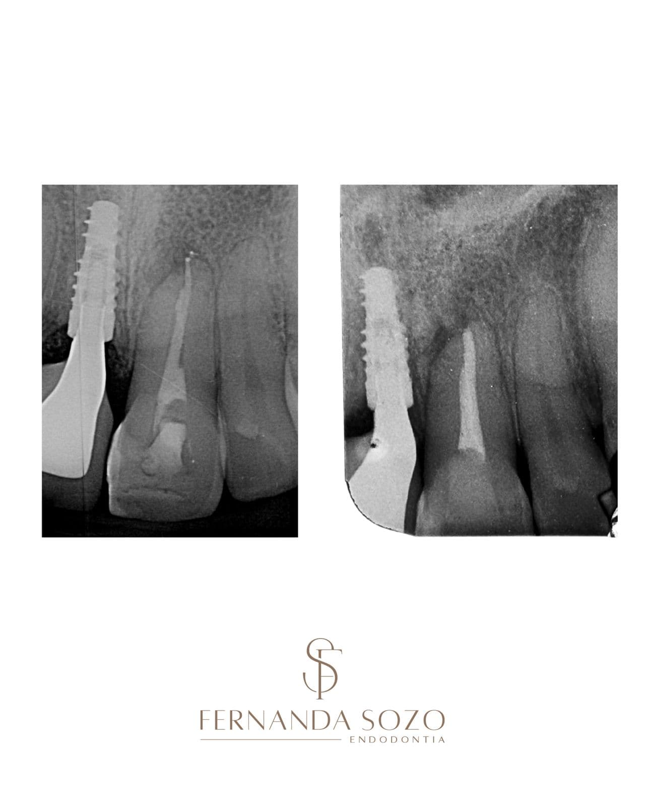 Tratamento endodôntico de molar inferior com três canais radiculares